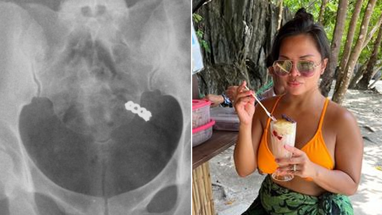 An X-ray reveals that a woman accidentally swallowed her wedding ring while taking vitamins.