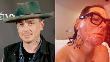 Sid Wilson of Slipknot describes the gruesome injuries he sustained in a bonfire explosion, stating, "My face is basically melted."