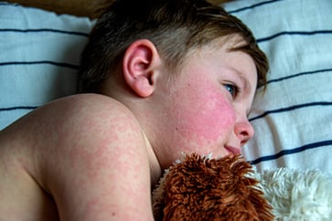 The incidence of Parvovirus, also known as 'slapped cheek disease,' is increasing, according to the CDC. It is crucial to be aware of its symptoms and preventive measures.