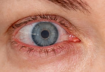 What are the reasons behind my frequently bloodshot eyes?