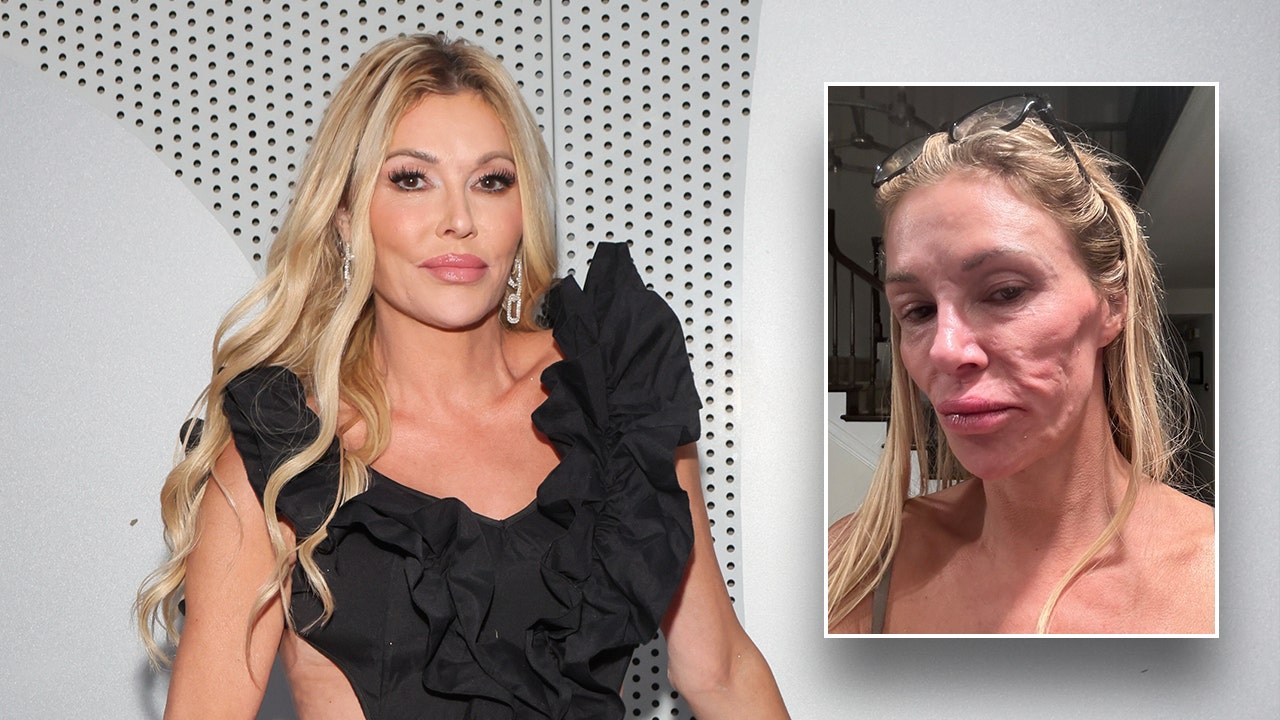 Brandi Glanville is investing all of her money in search of answers to the mystery illness that has left her disfigured.